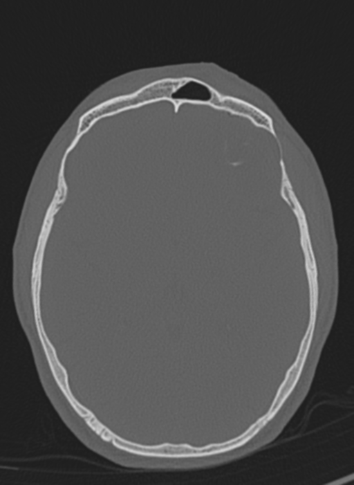 Anaplastic oligodendroglioma with skull fracture (Radiopaedia 74831-85846 Axial bone window 34).png