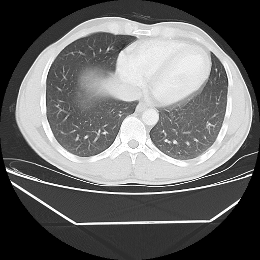 File:Aneurysmal bone cyst - rib (Radiopaedia 82167-96220 Axial lung window 47).jpg