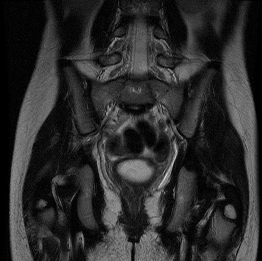 File:Aneurysmal bone cyst - sacrum (Radiopaedia 65190-74196 Coronal T2 14).jpg