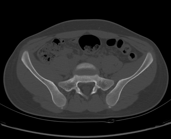 File:Aneurysmal bone cyst of ischium (Radiopaedia 25957-26094 Axial bone window 19).png