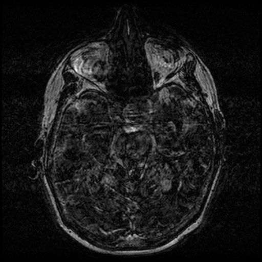Angioinvasive aspergillosis in the pituitary fossa (Radiopaedia 39676-42010 Ax 3D FIESTA VOLUME 48).png