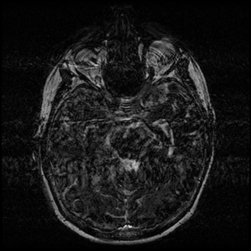 Angioinvasive aspergillosis in the pituitary fossa (Radiopaedia 39676-42010 Ax 3D FIESTA VOLUME 61).png