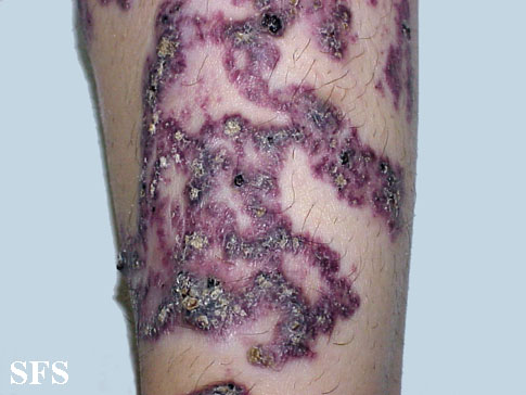 Angiokeratoma Circumscriptum (Dermatology Atlas 16).jpg