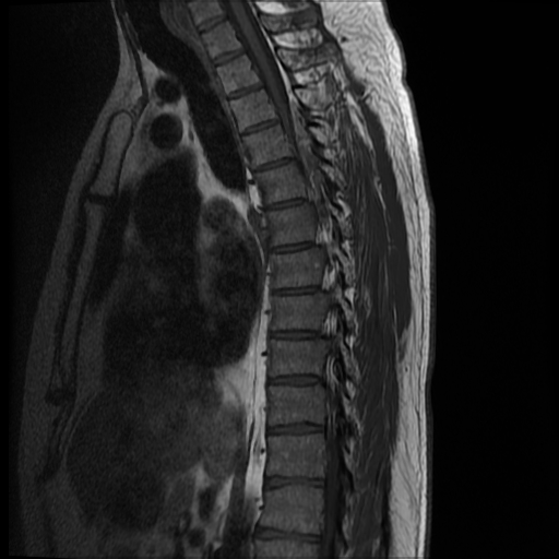 File:Angiolipoma - thoracic spine (Radiopaedia 28242-28479 Sagittal T1 6).jpg