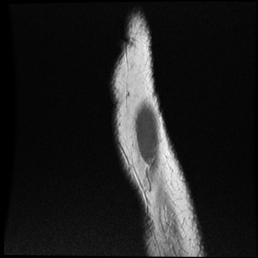 File:Anomalous insertion of the medial meniscus (Radiopaedia 77559-89721 Sagittal PD 5).jpg