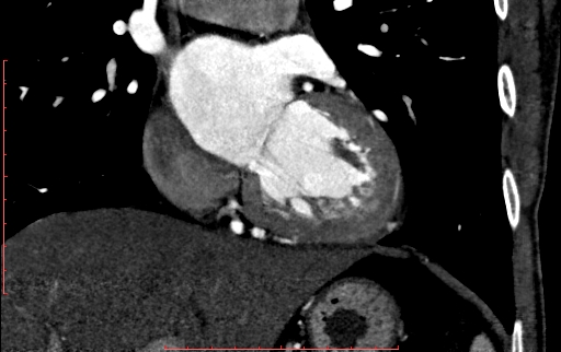Anomalous left coronary artery from the pulmonary artery (ALCAPA) (Radiopaedia 70148-80181 B 163).jpg