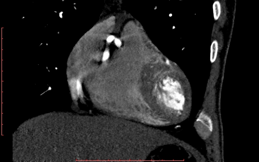 Anomalous left coronary artery from the pulmonary artery (ALCAPA) (Radiopaedia 70148-80181 B 77).jpg
