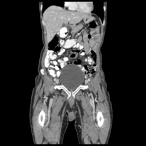 Anorectal carcinoma (Radiopaedia 44413-48064 B 18).jpg