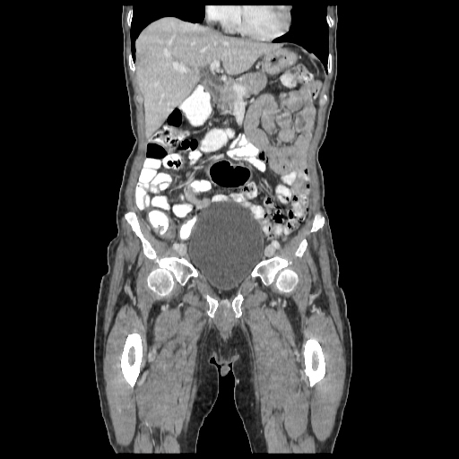 Anorectal carcinoma (Radiopaedia 44413-48064 B 23).jpg