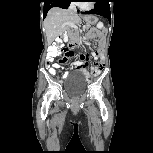 Anorectal carcinoma (Radiopaedia 44413-48064 B 32).jpg