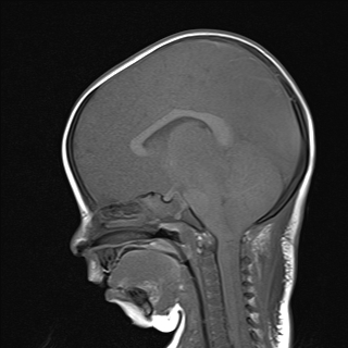 File:Anoxic brain injury (Radiopaedia 79165-92139 Sagittal T1 11).jpg