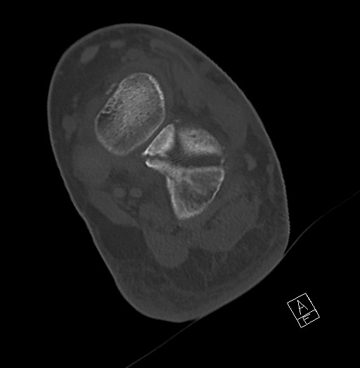 Anterior calcaneal process fracture (Radiopaedia 63353-71943 Axial bone window 92).jpg