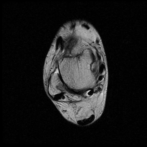 File:Anterior calcaneal process fracture (Radiopaedia 71377-81705 Axial T2 7).jpg