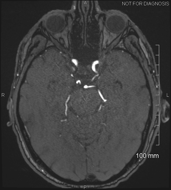 Anterior cerebral artery aneurysm (Radiopaedia 80683-94127 Axial MRA 88).jpg