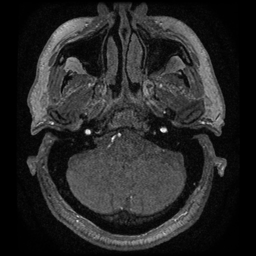 Anterior cerebral artery infarction (Radiopaedia 46794-51323 Axial MRA 8).jpg
