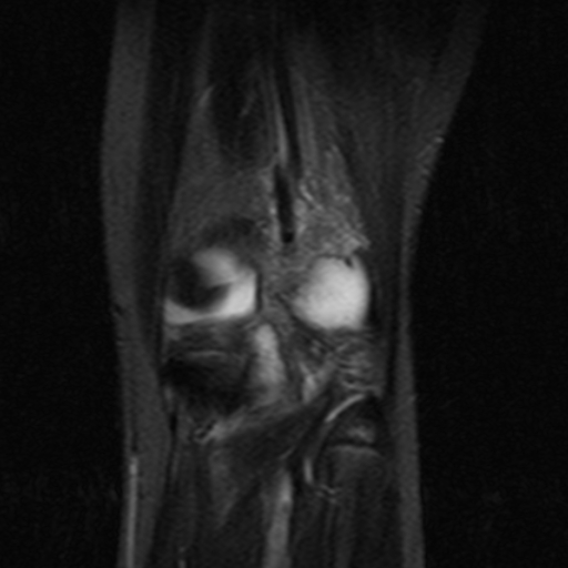 File:Anterior cruciate ligament avulsion fracture (Radiopaedia 24710-24974 Coronal STIR 11).jpg