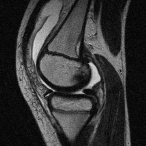 File:Anterior cruciate ligament avulsion fracture (Radiopaedia 24710-24974 Sagittal T2 3).jpg