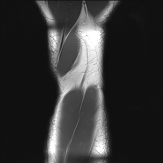 File:Anterior cruciate ligament full thickness tear (Radiopaedia 66268-75467 Coronal T1 23).jpg