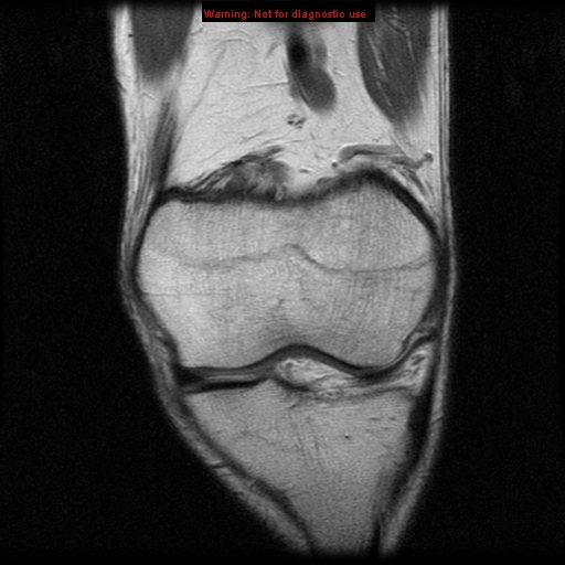 File:Anterior cruciate ligament injury - partial thickness tear (Radiopaedia 12176-12515 D 2).jpg