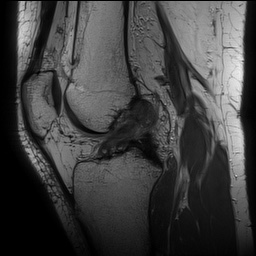 Anterior cruciate ligament rupture with Segond fracture (Radiopaedia 69043-78806 Sagittal PD 98).jpg