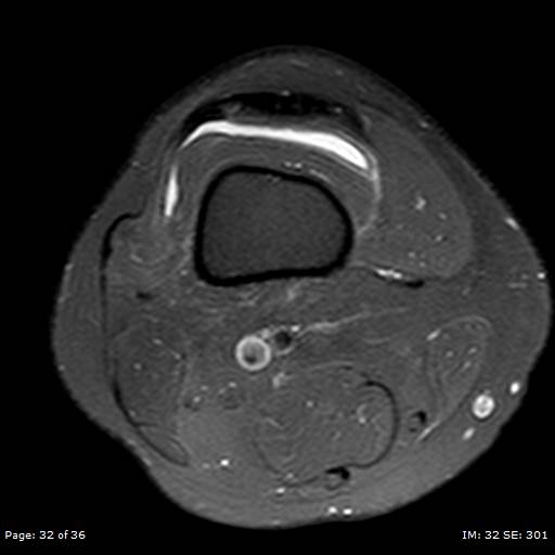 File:Anterior cruciate ligament tear (Radiopaedia 70783-80964 Axial PD fat sat 32).jpg