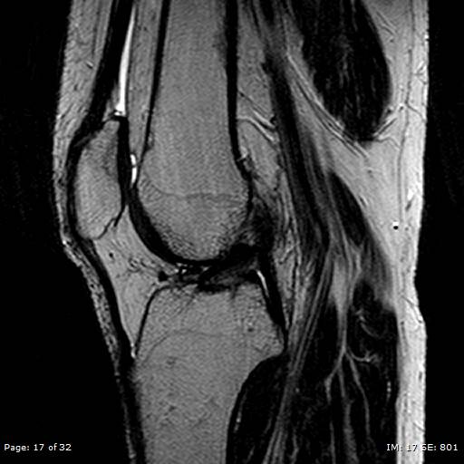 File:Anterior cruciate ligament tear (Radiopaedia 70783-80964 Sagittal T2 17).jpg