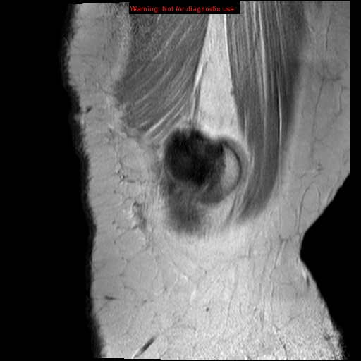 File:Anterior cruciate ligament tear - complete (Radiopaedia 12175-12514 Sagittal PD 20).jpg