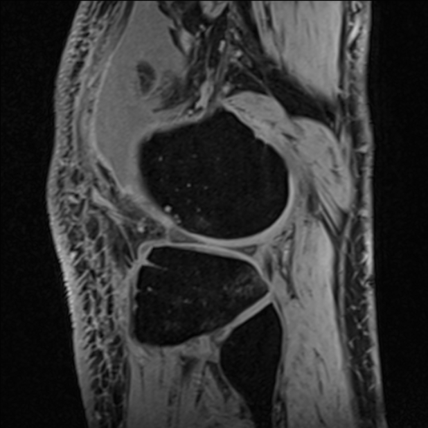 Anterior cruciate ligament tear - ramp lesion (Radiopaedia 71883-82322 Sagittal T1 vibe 33).jpg