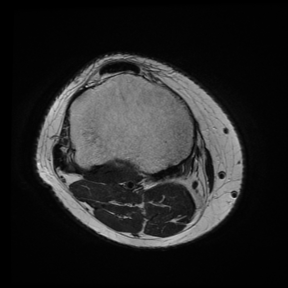 File:Anterior cruciate ligament tear with posteromedial corner injury, bucket-handle meniscal tear and chondral delamination (Radiopaedia 75501-86744 Axial T2 3).jpg