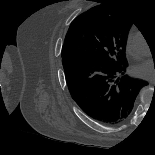 File:Anterior glenohumeral dislocation with Hill-Sachs lesion (Radiopaedia 62877-71249 Axial bone window 107).jpg