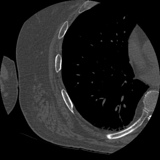 File:Anterior glenohumeral dislocation with Hill-Sachs lesion (Radiopaedia 62877-71249 Axial bone window 116).jpg