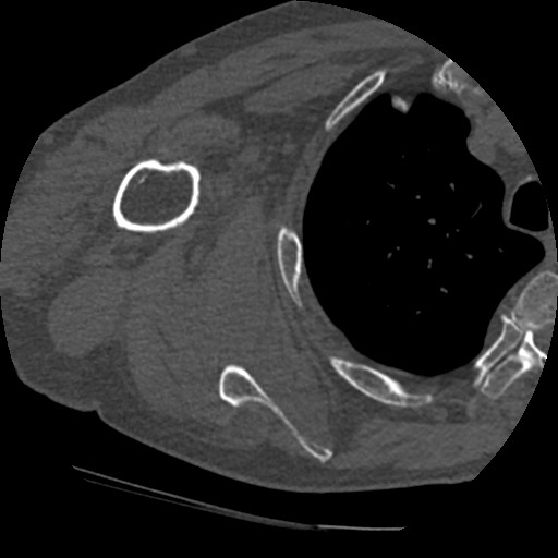 Anterior glenohumeral dislocation with Hill-Sachs lesion (Radiopaedia 62877-71249 Axial bone window 59).jpg