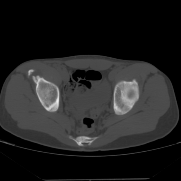 Anterior inferior iliac spine avulsion fracture (Radiopaedia 49469-54627 Axial bone window 32).jpg