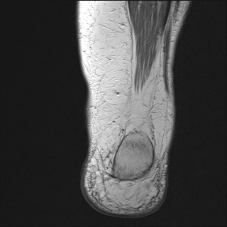 File:Anterior talofibular ligament injury - rupture with soft-tissue impingement (Radiopaedia 38765-40928 Coronal PD 4).jpg