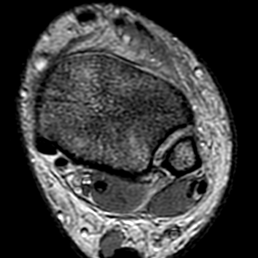 File:Anterior talofibular ligament rupture (Radiopaedia 15831-15484 Axial T2* 3).jpg