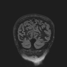 Anterior temporal encephalocele (Radiopaedia 82624-96808 Coronal FLAIR 46).jpg
