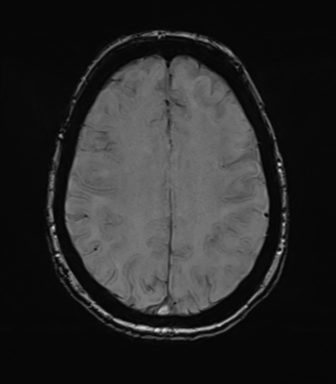 Anterior temporal pole cysts (Radiopaedia 46629-51102 Axial SWI 62).png