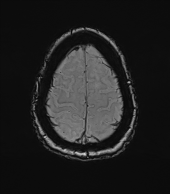 Anterior temporal pole cysts (Radiopaedia 46629-51102 Axial SWI 75).png