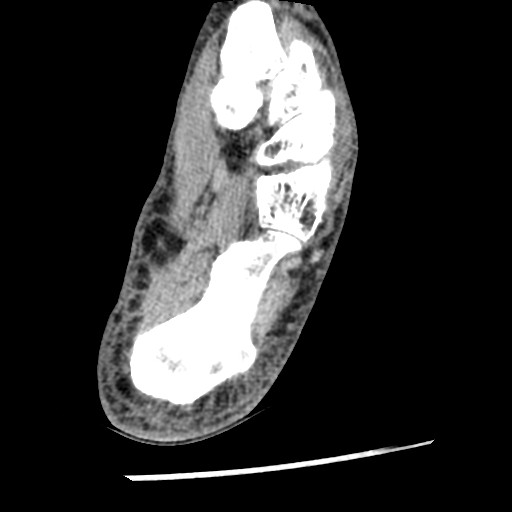 Anterior tibial artery false aneurysm (Radiopaedia 88984-105809 A 205).jpg
