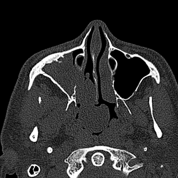 Antrochoanal polyp (Radiopaedia 30002-30554 Axial bone window 23).jpg
