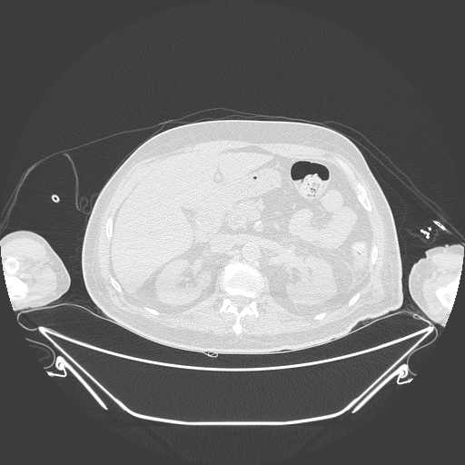 Aortic arch aneurysm (Radiopaedia 84109-99365 Axial lung window 310).jpg
