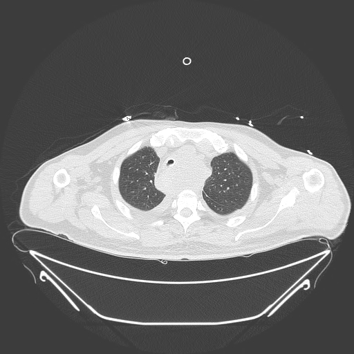 Aortic arch aneurysm (Radiopaedia 84109-99365 Axial lung window 72).jpg