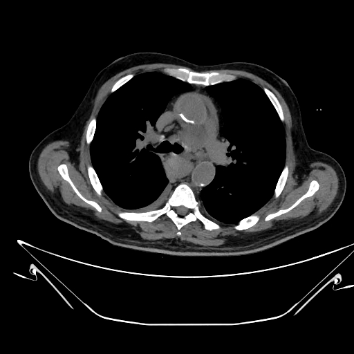 Aortic arch aneurysm (Radiopaedia 84109-99365 Axial non-contrast 113).jpg