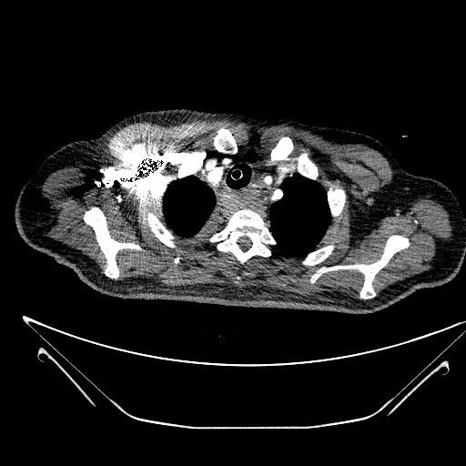 Aortic arch aneurysm (Radiopaedia 84109-99365 B 98).jpg