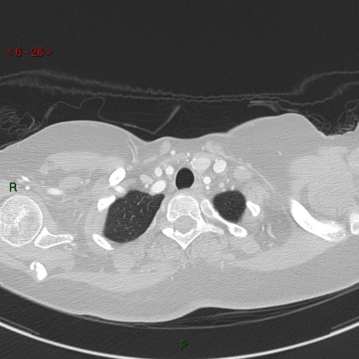 Aortic arch origin of left vertebral artery (Radiopaedia 51520-57286 Axial lung window 26).jpg