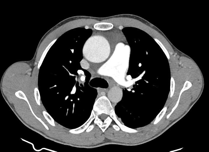 File:Aortic coarctation with aneurysm (Radiopaedia 74818-85828 A 130).jpg