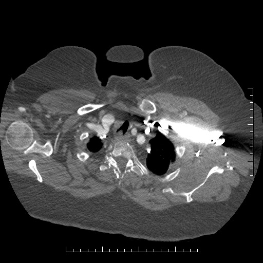 File:Aortic dissection- Stanford A (Radiopaedia 35729-37268 A 1).jpg
