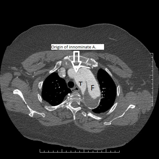 File:Aortic dissection- Stanford A (Radiopaedia 35729-39076 Multiple Annotated 1).jpg