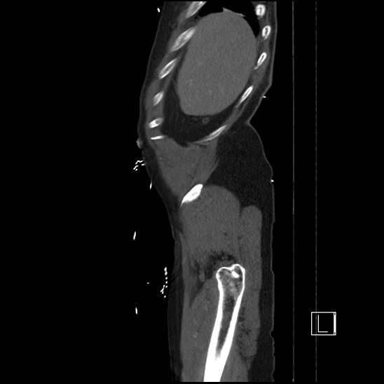 Aortic dissection (CTPA) (Radiopaedia 75506-86750 G 9).jpg