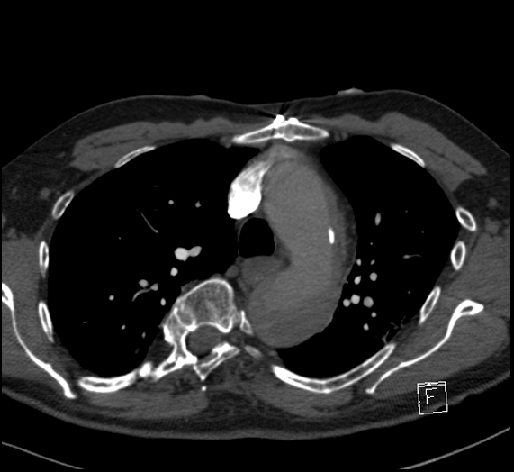 File:Aortic dissection (CTPA) (Radiopaedia 75506-86751 Axial C+ CTPA 45).jpg